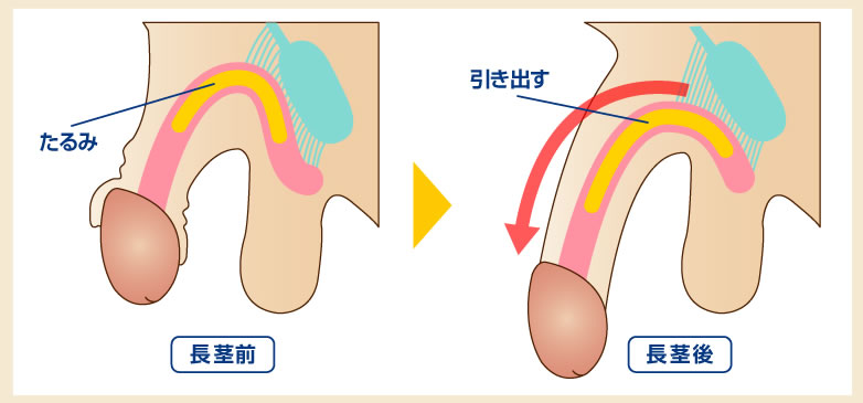 長茎術図解