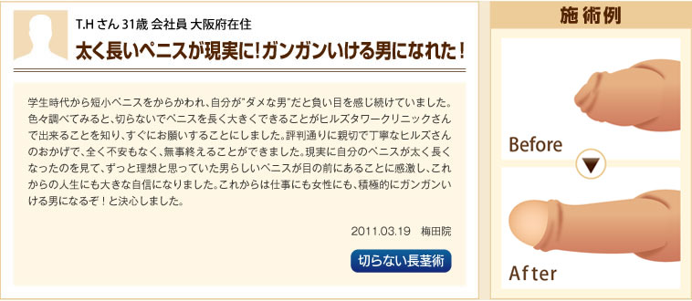 施術例・切らない長茎術