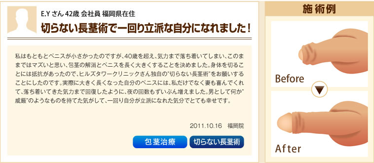 施術例・包茎治療、切らない長茎術